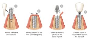 Dental Implant Brisbane Southside Dental Group