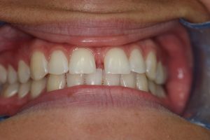 Diastema Gap Tooth Brisbane Orthodontics Before and After