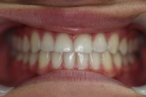 Braces Before and After Brisbane South