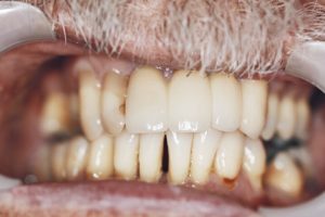 Dental Implant Brisbane Dentist