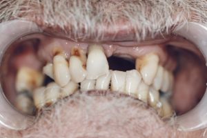 Smile Transformation Before and After Brisbane Dentist